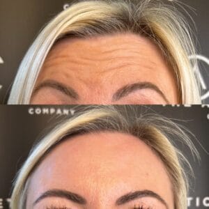 Anti Wrinkle Before After 01