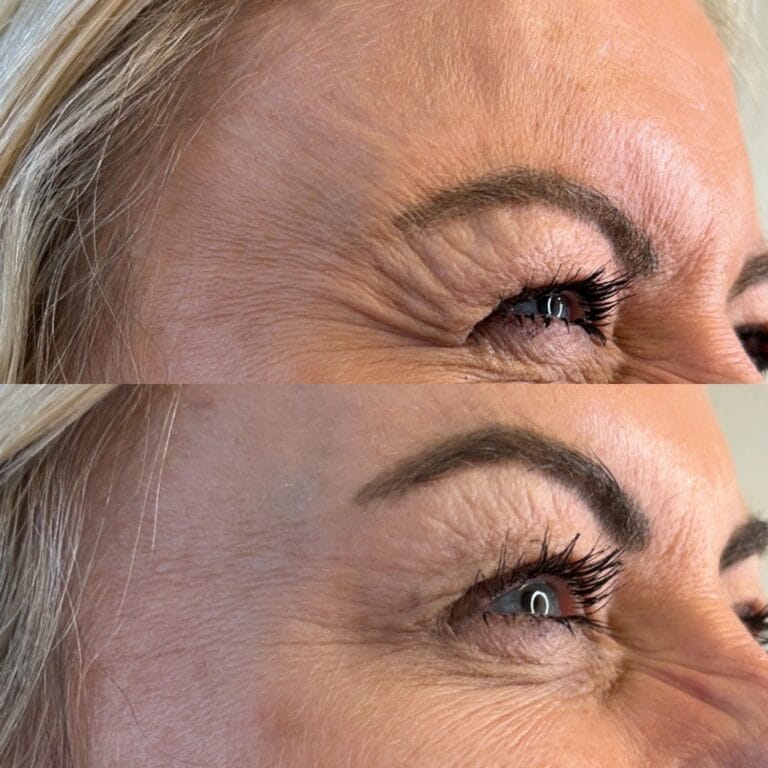 Anti Wrinkle Before After 02