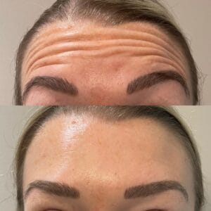 Anti Wrinkle Before After 04