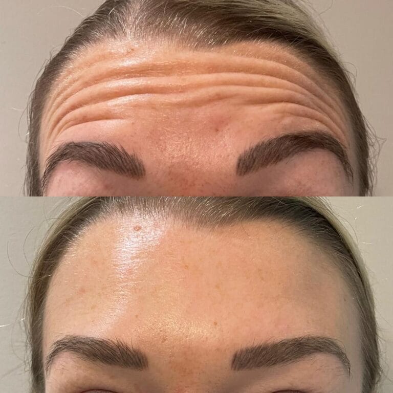 Anti Wrinkle Before After 04