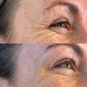 Anti Wrinkle Before After 05