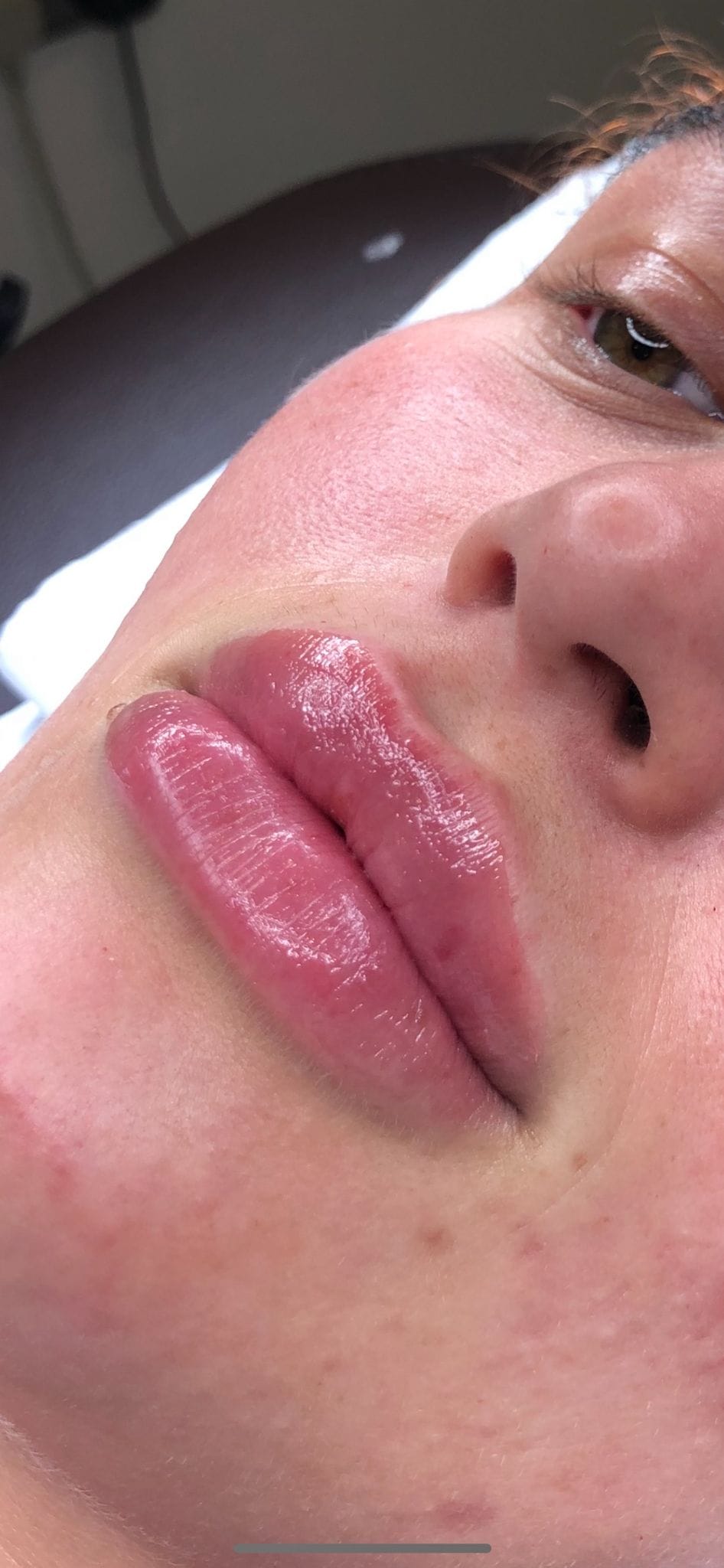 Lip Fillers 01